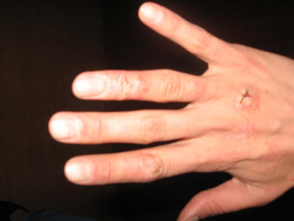 dermatitis atópica2