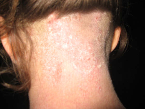 dermatitis atópica3