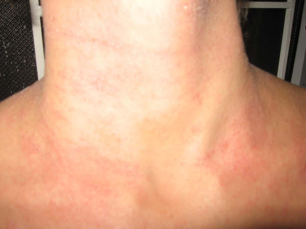 dermatitis atópica4