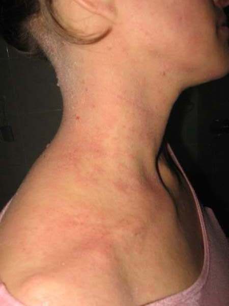 dermatitis atópica5