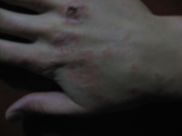 dermatitis atópica6