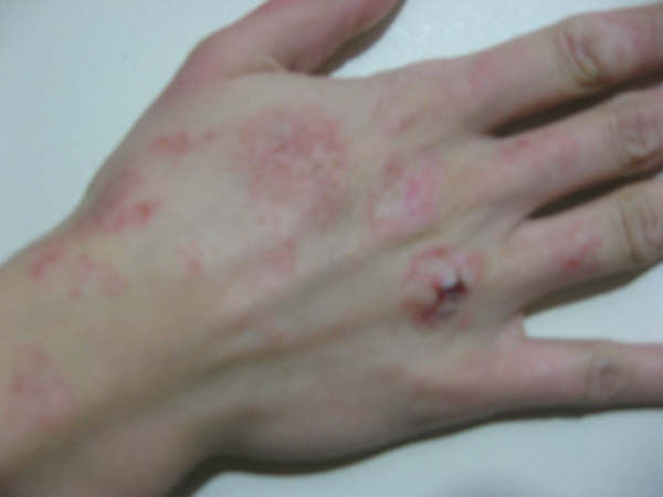 dermatitis atópica8
