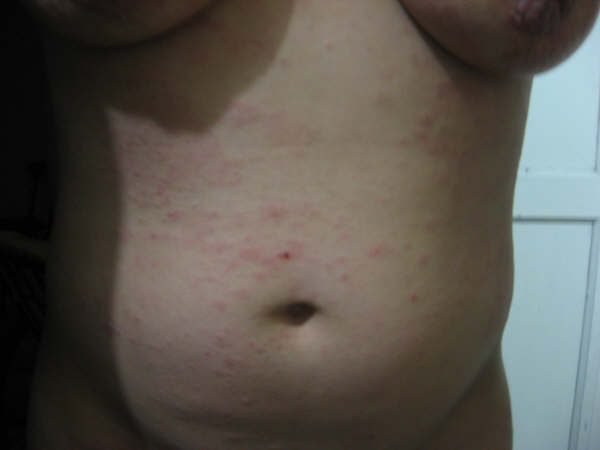 dermatitis atópica9