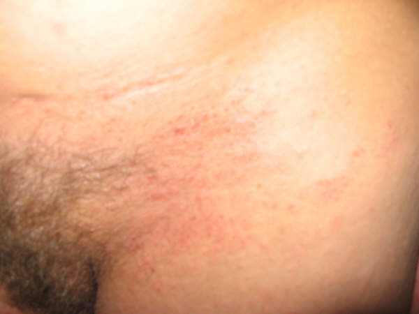 dermatitis atópica10