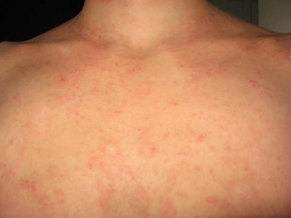 dermatitis atópica11