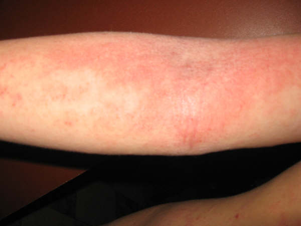 dermatitis atópica12