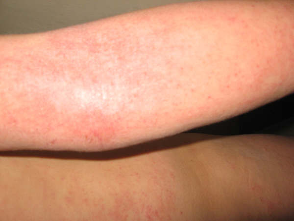 dermatitis atópica13