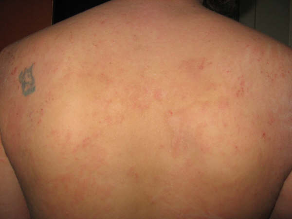 dermatitis atópica14