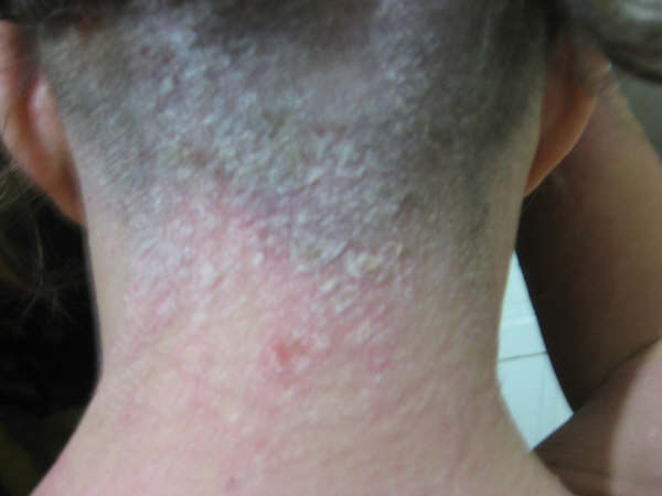 dermatitis atópica15