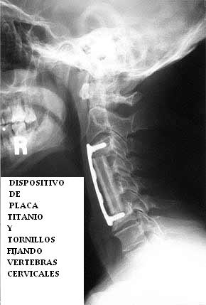 cirujia_discos_cervicales