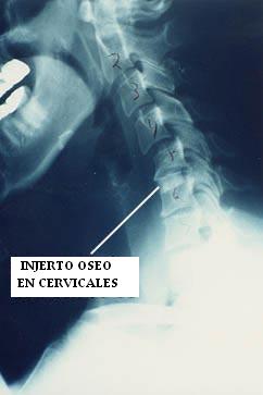 injerto_oseo_en_cervicales
