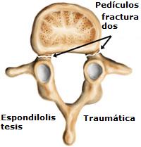 espondilolistesis_traumática