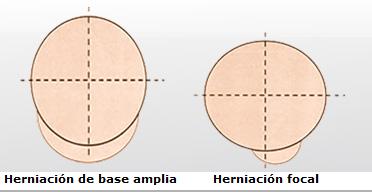 abombamiento_multidireccional