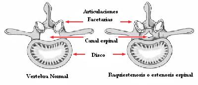 raquiestenosis