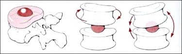 Movilidad_de_un_disco_intervertebral