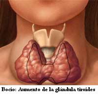 bocio_aumento_glandula_tiroides