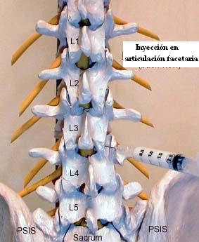 inyeccion_faceta_lumbar