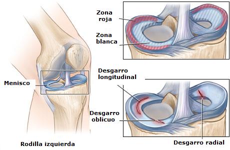 menisco_roto_desgarrado