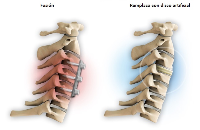 fusion_remplazo_disco