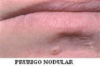 prurigo_nodular