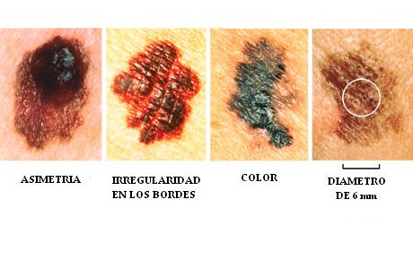 cancer_de_piel_melanoma