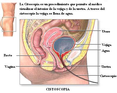 cistoscopia