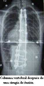 Columna vertebral despues de una cirugia de fusion