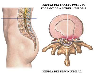 hernia_nucleo_pulposo