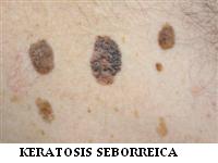 keratosis_seborreica