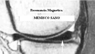 menisco_sano