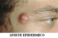 quiste_epidermico