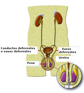 uretrotomia