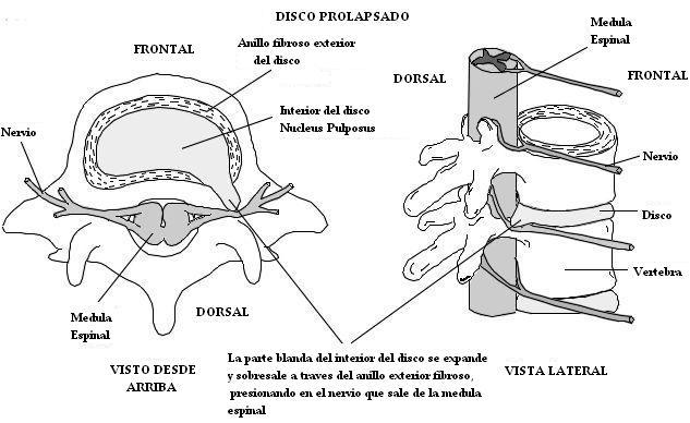 disco_prolapsado