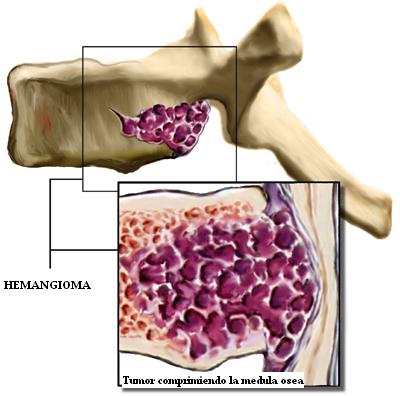 hemangioma