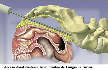 Acceso Axial -Sistema Axial Lumbar de Cirugía de Fusión
