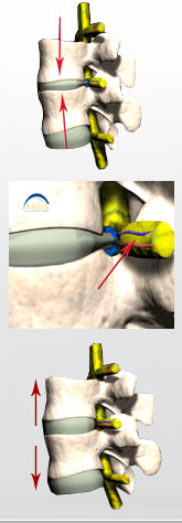 descompresion_vertebras