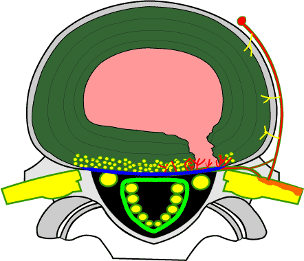 disco_intervertebral_sale_de_sus_limites_formando_protuberancia