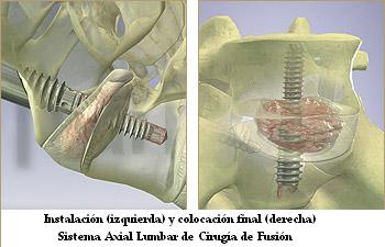 Instalación (izquierda) y colocación final (derecha) - Sistema Axial Lumbar de Cirugía de Fusión de Cuerpos Vertebrales