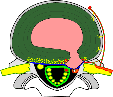 protrusion