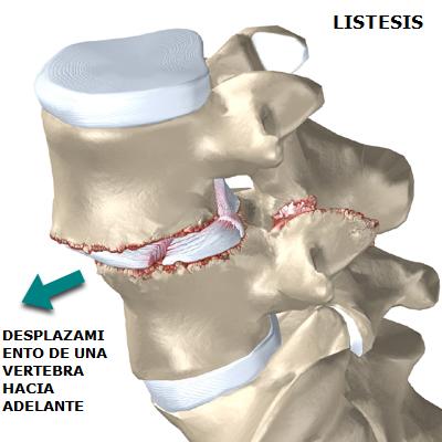 listesis