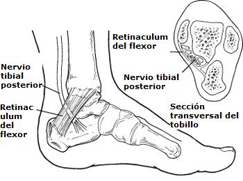 sindrome_del_tunel_tarsiano