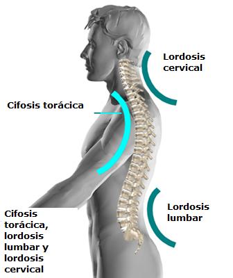 cifosis_toracica