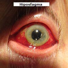 hiposfagma