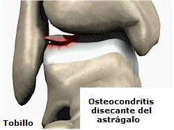 Osteocondritis disecante del astrágalo