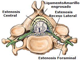 tipos_de_estenosis