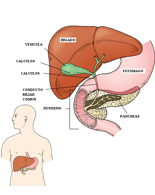 vesicula_calculos