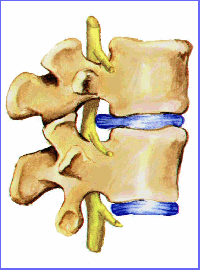 hernia_discal_afectando_medula_espinal