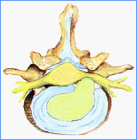 herniacion_disco_intervertebral