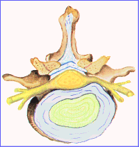 protrusion_disco_intervertebral