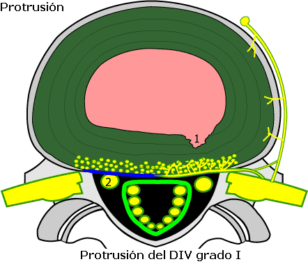 protrusion_discal_grado_uno